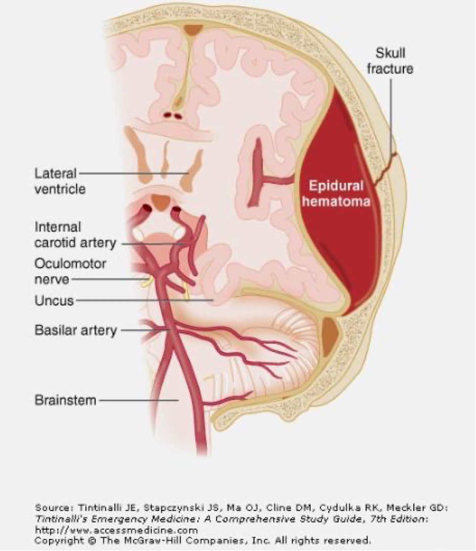 uncal herniation cranial nerve 3